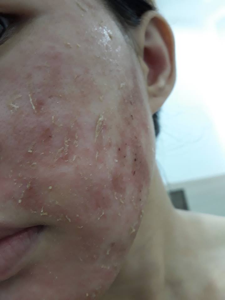 Spa Shynh House bị nhiều khách hàng tố làm hỏng da sau khi kết thúc liệu trình lăn kim